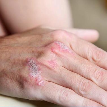Asd 2 domande per psoriasi