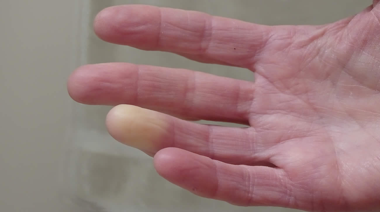 Biofeedback per la sindrome di Raynaud