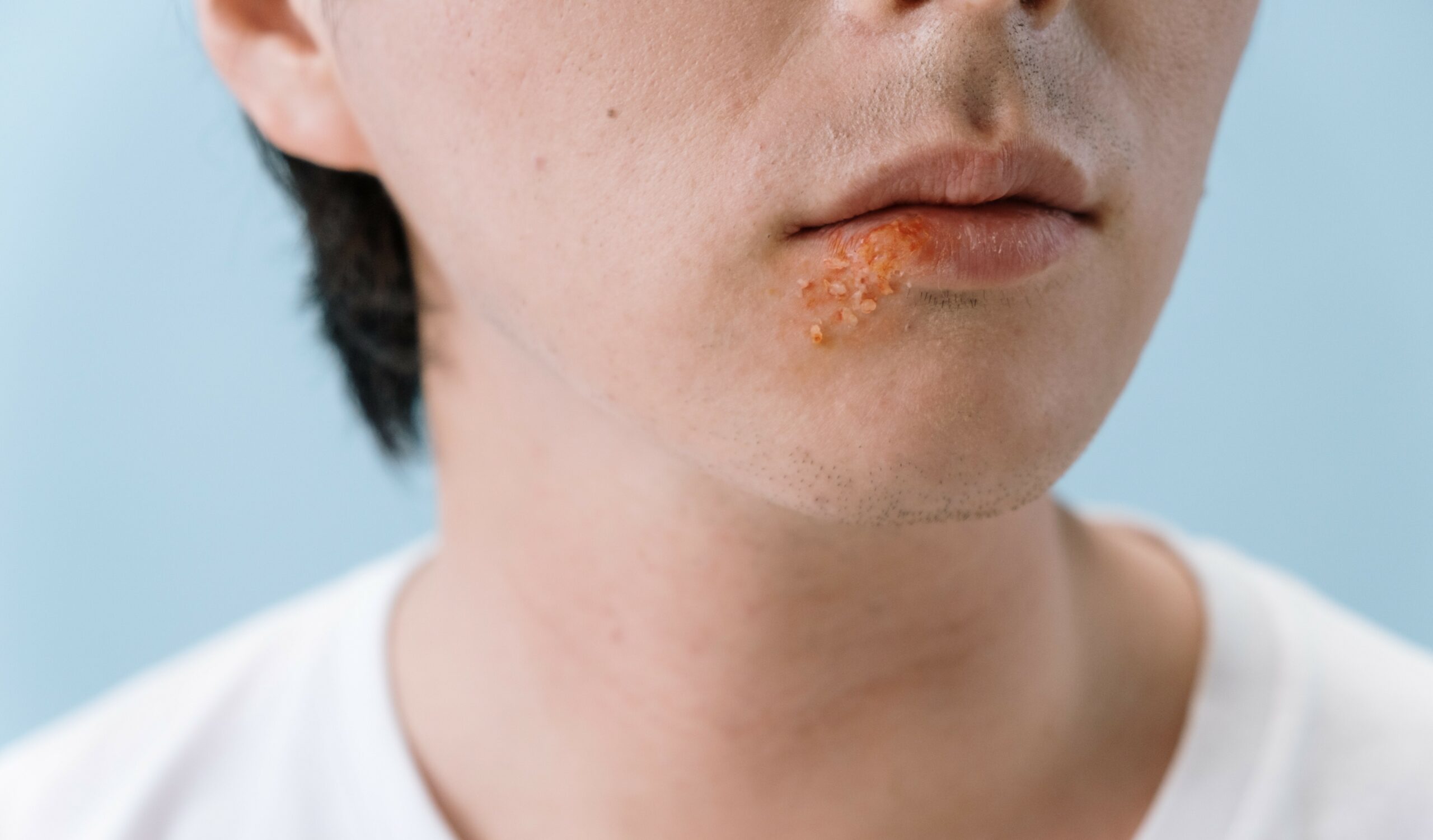 Herpes: sintomi e trattamento