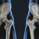 osteoporosi come fare prevenzione
