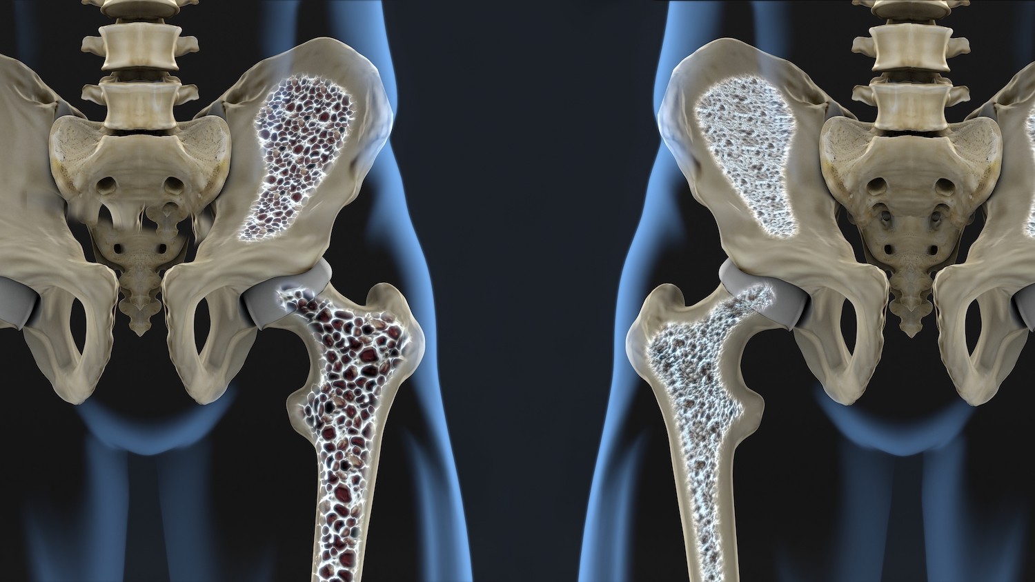 Osteoporosi come fare prevenzione